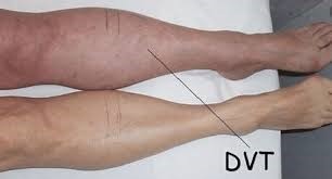 VTE Prophylaxis(圖1)