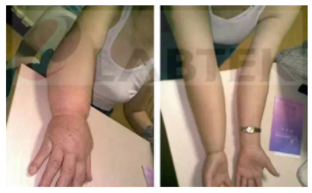 Lymphedema Of The Right Arm After Breast Surgery(圖1)