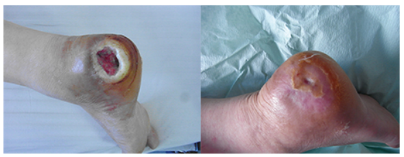 Diabetic Foot(圖1)