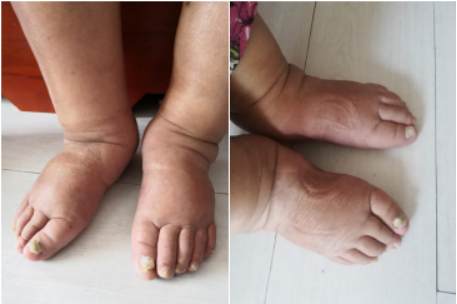 Limb Edema Caused By Poor Blood Circulation(圖1)