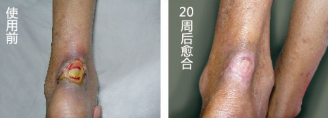 李某，右下肢深靜脈功能不全(圖1)